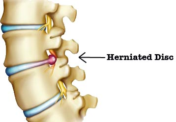 http://fitness4backpain.com/wp-content/uploads/Herniated-disc2-resized-600_jpg.png