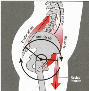 fixing anterior pelvic tilt