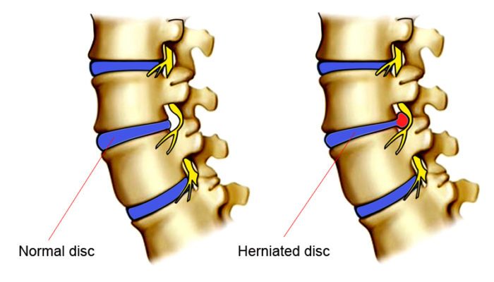 core exercises for herniated disc, core exercises for bulging disc, bulging disc exercise, ruptured disc core exercise, safe ab exercises for herniated disc, herniated disk, herniated disc, exercising with herniated disc