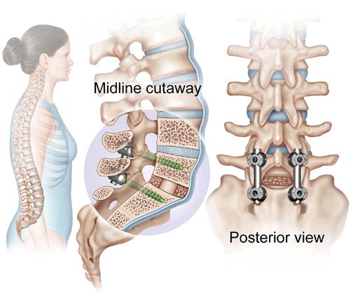 How to Sleep after Back Surgery  Spinal fusion, Spinal fracture,  Laminectomy, Back injury 